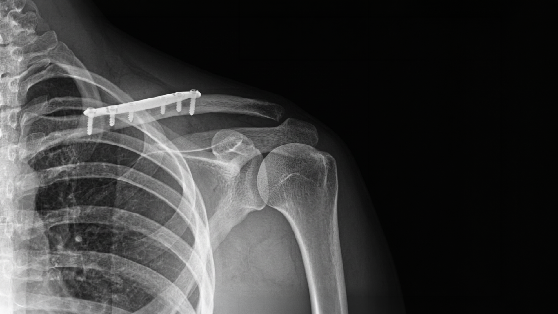 OsteoTech Implantes Banner